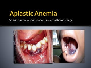 Aplastic anemia spontaneous mucosal hemorrhage
 