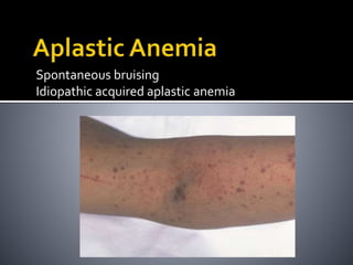 Spontaneous bruising
Idiopathic acquired aplastic anemia
 
