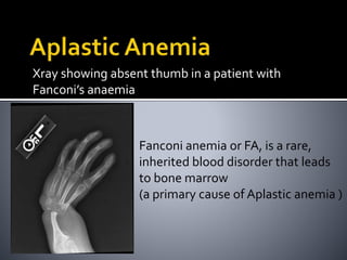 Xray showing absent thumb in a patient with
Fanconi’s anaemia
Fanconi anemia or FA, is a rare,
inherited blood disorder that leads
to bone marrow
(a primary cause of Aplastic anemia )
 