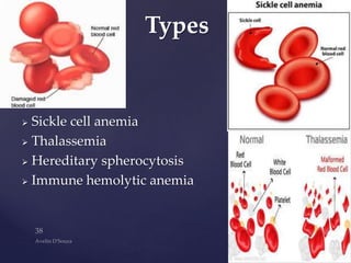  Sickle cell anemia
 Thalassemia
 Hereditary spherocytosis
 Immune hemolytic anemia
Types
 