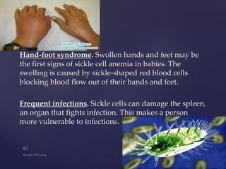 Hand-foot syndrome. Swollen hands and feet may be
the first signs of sickle cell anemia in babies. The
swelling is caused by sickle-shaped red blood cells
blocking blood flow out of their hands and feet.
Frequent infections. Sickle cells can damage the spleen,
an organ that fights infection. This makes a person
more vulnerable to infections.
 