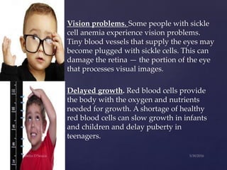 Vision problems. Some people with sickle
cell anemia experience vision problems.
Tiny blood vessels that supply the eyes may
become plugged with sickle cells. This can
damage the retina — the portion of the eye
that processes visual images.
Delayed growth. Red blood cells provide
the body with the oxygen and nutrients
needed for growth. A shortage of healthy
red blood cells can slow growth in infants
and children and delay puberty in
teenagers.
 