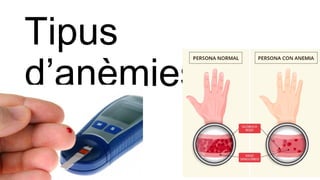 Tipus
d’anèmies
 