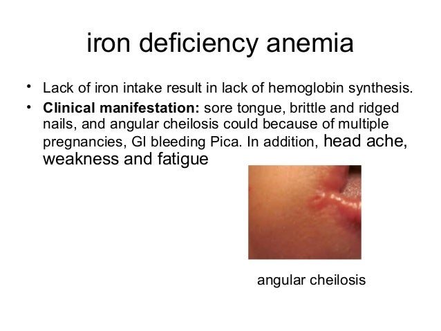 Anemia