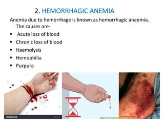 2. HEMORRHAGIC ANEMIA
Anemia due to hemorrhage is known as hemorrhagic anaemia.
The causes are-
 Acute loss of blood
 Chronic loss of blood
 Haemolysis
 Hemophilia
 Purpura
 