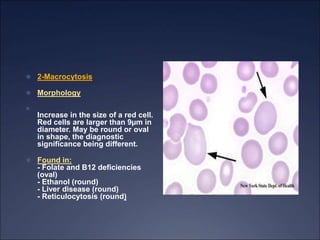  2-Macrocytosis
 Morphology

Increase in the size of a red cell.
Red cells are larger than 9µm in
diameter. May be round or oval
in shape, the diagnostic
significance being different.
 Found in:
- Folate and B12 deficiencies
(oval)
- Ethanol (round)
- Liver disease (round)
- Reticulocytosis (round)
 