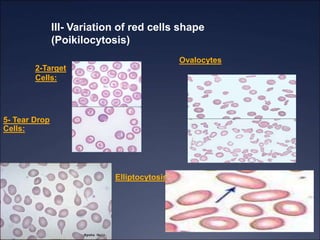 III- Variation of red cells shape
(Poikilocytosis)
2-Target
Cells:
Ovalocytes
Elliptocytosis
5- Tear Drop
Cells:
 