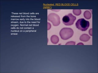 Nucleated RED BLOOD CELLS
(NRBC)
These red blood cells are
released from the bone
marrow early into the blood
stream, due to the need for
oxygen. Normal red blood
cells do not contain a
nucleus on a peripheral
smear.
 