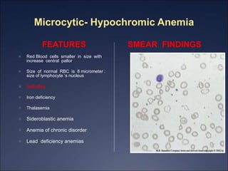 Microcytic- Hypochromic Anemia
FEATURES
 Red Blood cells smaller in size with
increase central pallor
 Size of normal RBC is 8 micrometer :
size of lymphocyte ‘s nucleus
 Includes
 Iron deficiency
 Thalasemia
 Sideroblastic anemia
 Anemia of chronic disorder
 Lead deficiency anemias
SMEAR FINDINGS
 