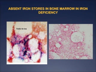 ABSENT IRON STORES IN BONE MARROW IN IRON
DEFICIENCY
 