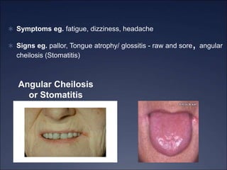  Symptoms eg. fatigue, dizziness, headache
 Signs eg. pallor, Tongue atrophy/ glossitis - raw and sore, angular
cheilosis (Stomatitis)
Angular Cheilosis
or Stomatitis
 