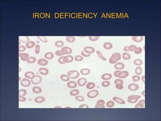 IRON DEFICIENCY ANEMIA
 