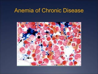 Anemia of Chronic Disease
 