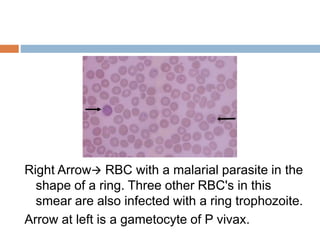 Anemia | PPTX