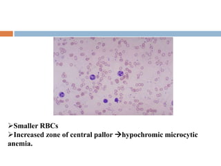 Anemia | PPTX