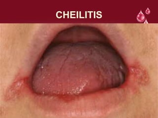 CHEILITIS
 