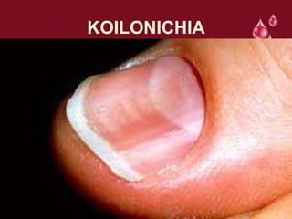 KOILONICHIA
 