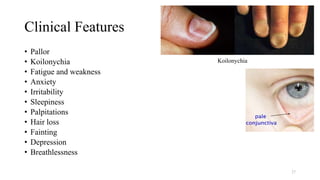 Clinical Features
• Pallor
• Koilonychia
• Fatigue and weakness
• Anxiety
• Irritability
• Sleepiness
• Palpitations
• Hair loss
• Fainting
• Depression
• Breathlessness
27
Koilonychia
 
