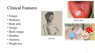 Clinical Features
• Fatigue
• Weakness
• Body ache
• Vertigo
• Beefy tongue
• Diarrhea
• Anorexia
• Weight loss
36
Beefy tongue
Anorexia
 