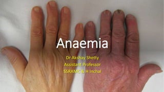 Anaemia
Dr Akshay Shetty
Assistant Professor
SSRAMC & H Inchal
 
