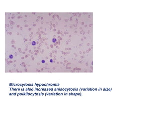 Microcytosis hypochromia
There is also increased anisocytosis (variation in size)
and poikilocytosis (variation in shape).
 