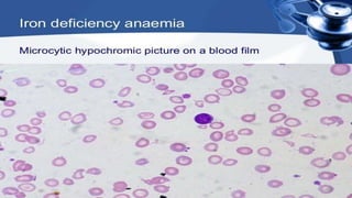 anemia.pptx