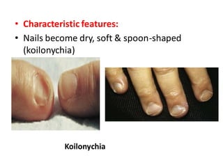 • Characteristic features:
• Nails become dry, soft & spoon-shaped
(koilonychia)
Koilonychia
 