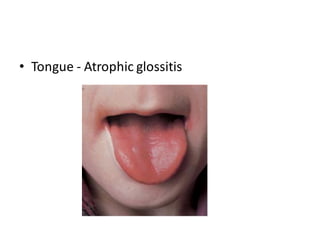 • Tongue - Atrophic glossitis
 
