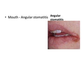 Angular
stomatitis
• Mouth - Angular stomatitis
 