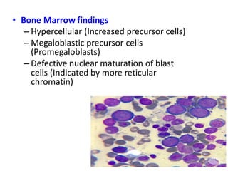 • Bone Marrow findings
– Hypercellular (Increased precursor cells)
– Megaloblastic precursor cells
(Promegaloblasts)
– Defective nuclear maturation of blast
cells (Indicated by more reticular
chromatin)
 