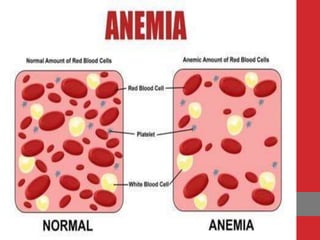Anemia.pptx