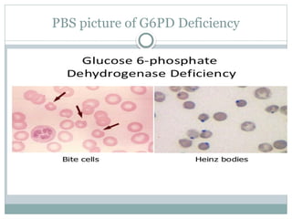 G6pd Deficiency Rbc Inclusions Anemia types and its management in medicine | PPTX