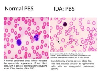 Normal PBS
Iron deficiency anemia, severe. Blood film.
The field displays virtually all hypochromic
cells with an exaggerated pale center
(arrow)
A normal peripheral blood smear indicates
the appropriate appearance of red blood
cells, with a zone of central pallor occupying
about 1/3 of the size of the RBC
IDA: PBS
 