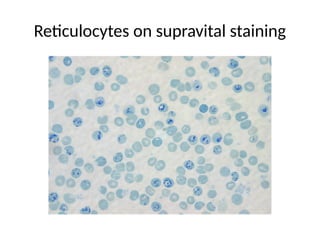 Reticulocytes on supravital staining
 