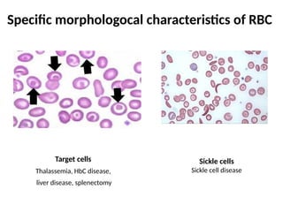 Specific morphologocal characteristics of RBC
Target cells
Thalassemia, HbC disease,
liver disease, splenectomy
Sickle cells
Sickle cell disease
 