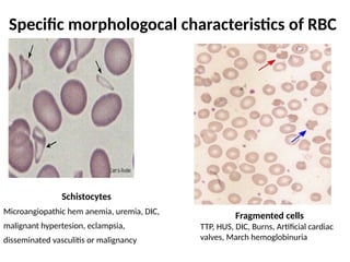 Specific morphologocal characteristics of RBC
Schistocytes
Microangiopathic hem anemia, uremia, DIC,
malignant hypertesion, eclampsia,
disseminated vasculitis or malignancy
Fragmented cells
TTP, HUS, DIC, Burns, Artificial cardiac
valves, March hemoglobinuria
 