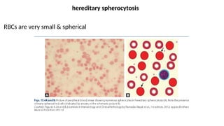 hereditary spherocytosis
RBCs are very small & spherical
 