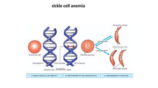 sickle cell anemia
 