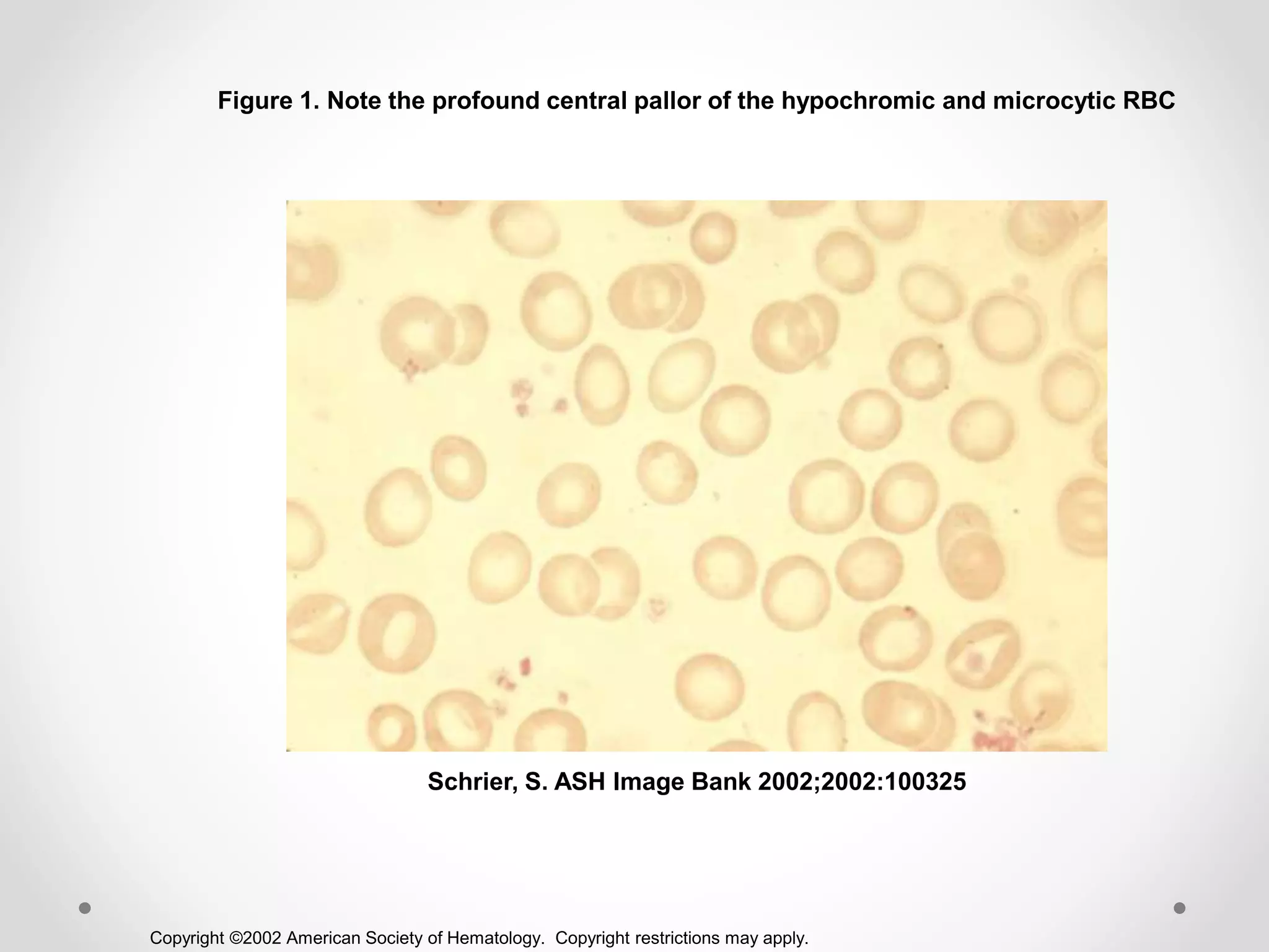 Copyright ©2002 American Society of Hematology. Copyright restrictions may apply.
Schrier, S. ASH Image Bank 2002;2002:100325
Figure 1. Note the profound central pallor of the hypochromic and microcytic RBC
 