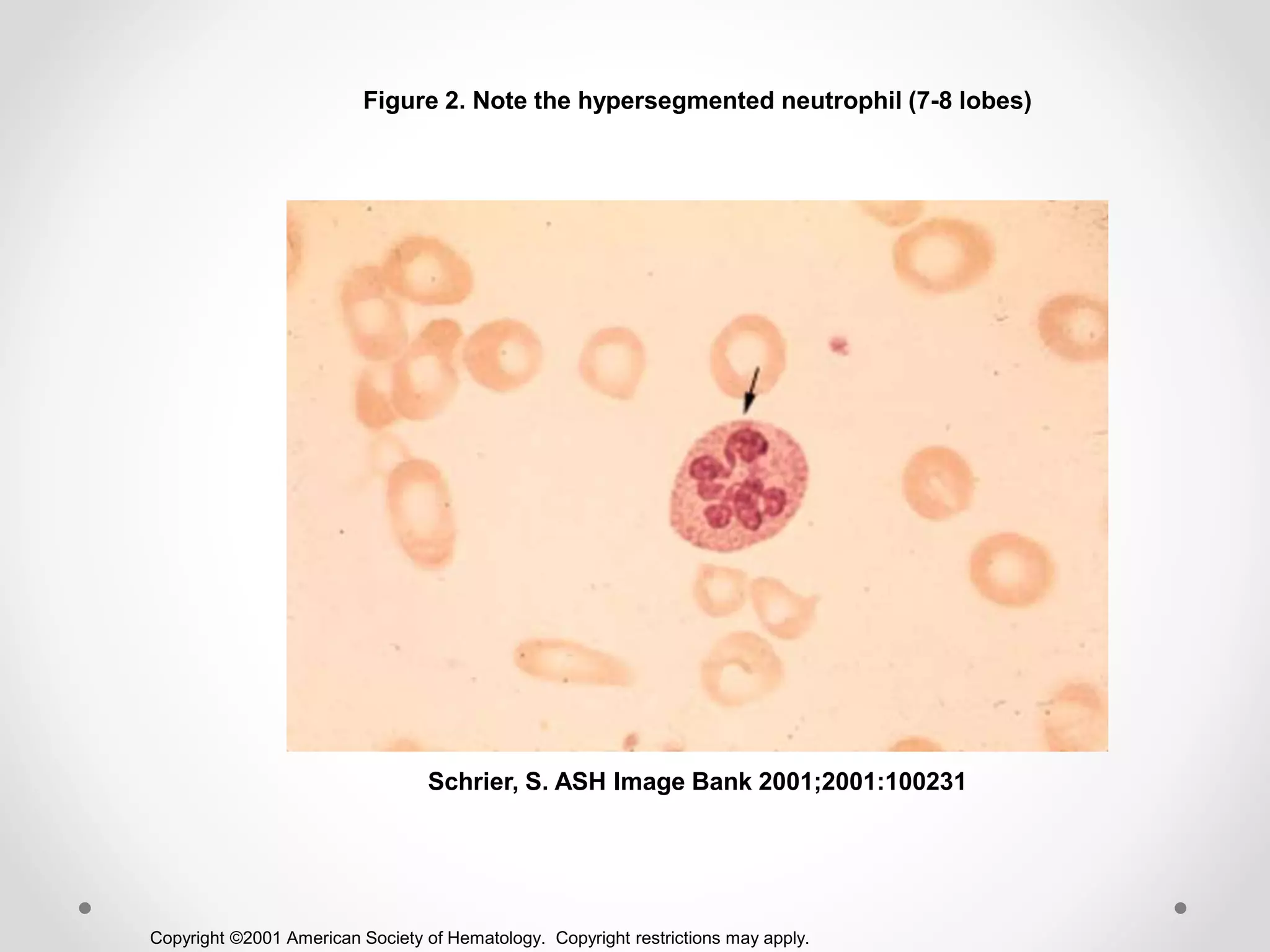 Copyright ©2001 American Society of Hematology. Copyright restrictions may apply.
Schrier, S. ASH Image Bank 2001;2001:100231
Figure 2. Note the hypersegmented neutrophil (7-8 lobes)
 