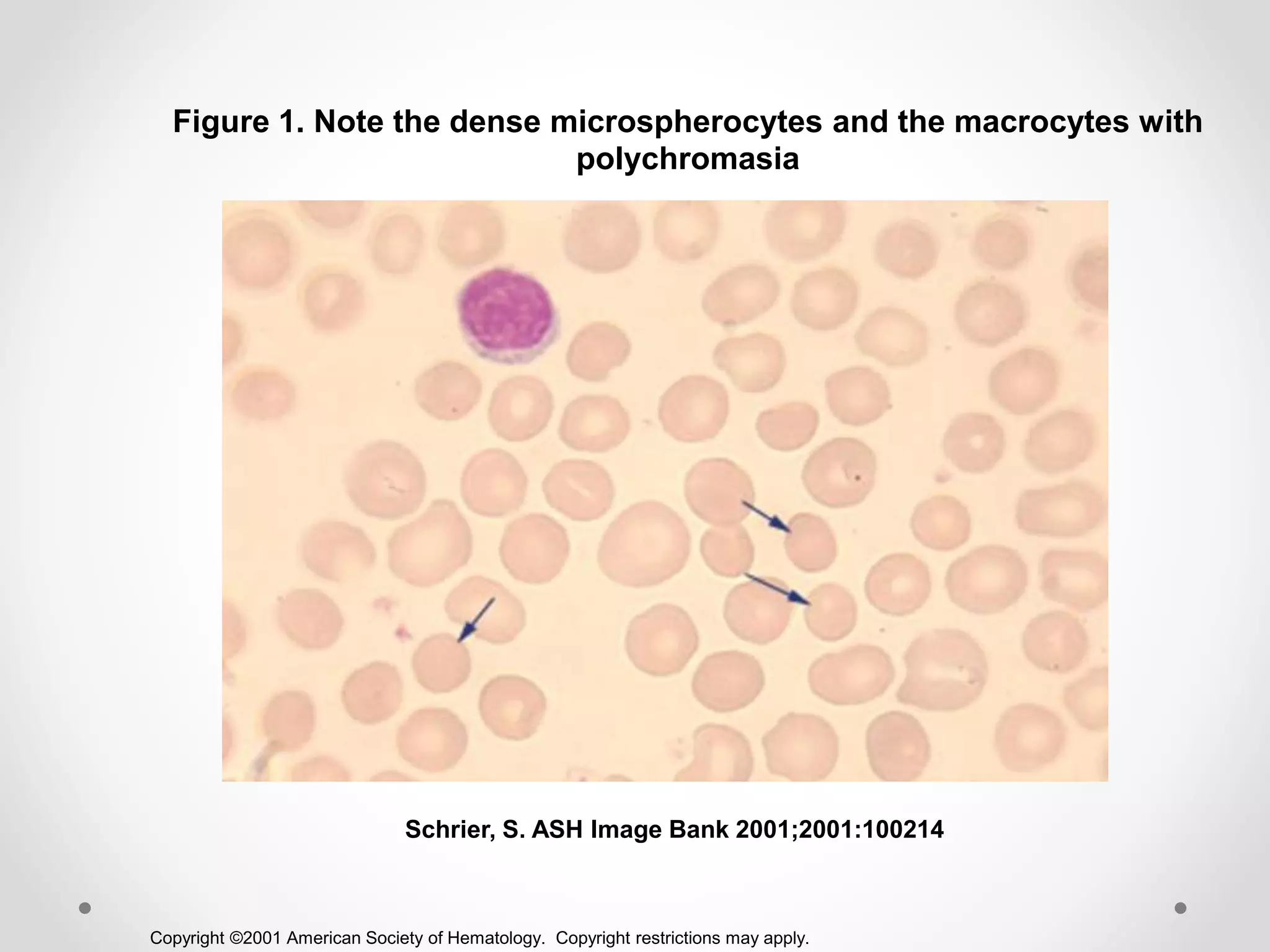Copyright ©2001 American Society of Hematology. Copyright restrictions may apply.
Schrier, S. ASH Image Bank 2001;2001:100214
Figure 1. Note the dense microspherocytes and the macrocytes with
polychromasia
 