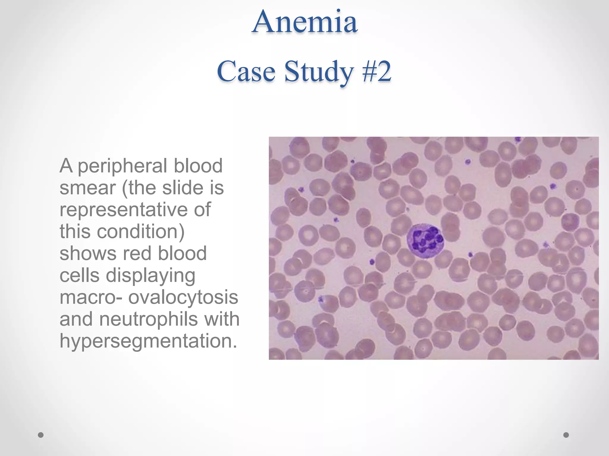 Anemia
Case Study #2
A peripheral blood
smear (the slide is
representative of
this condition)
shows red blood
cells displaying
macro- ovalocytosis
and neutrophils with
hypersegmentation.
 
