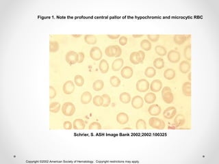 Anemia basic and approach | PPTX