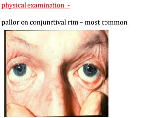 physical examination -
pallor on conjunctival rim – most common
 