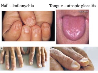 Nail – koilonychia Tongue – atropic glossitis
 