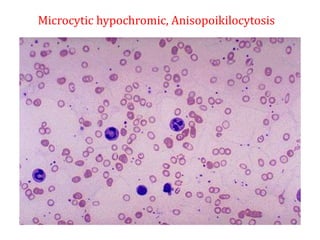 Microcytic hypochromic, Anisopoikilocytosis
 