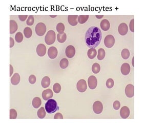 Macrocytic RBCs – ovalocytes +
 