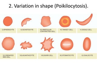 2. Variation in shape (Poikilocytosis).
 