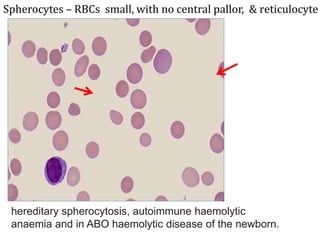 Spherocytes – RBCs small, with no central pallor, & reticulocyte
hereditary spherocytosis, autoimmune haemolytic
anaemia and in ABO haemolytic disease of the newborn.
 