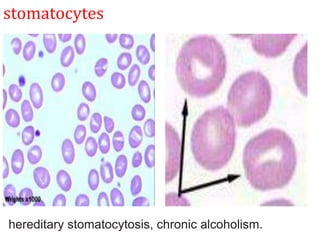 stomatocytes
hereditary stomatocytosis, chronic alcoholism.
 